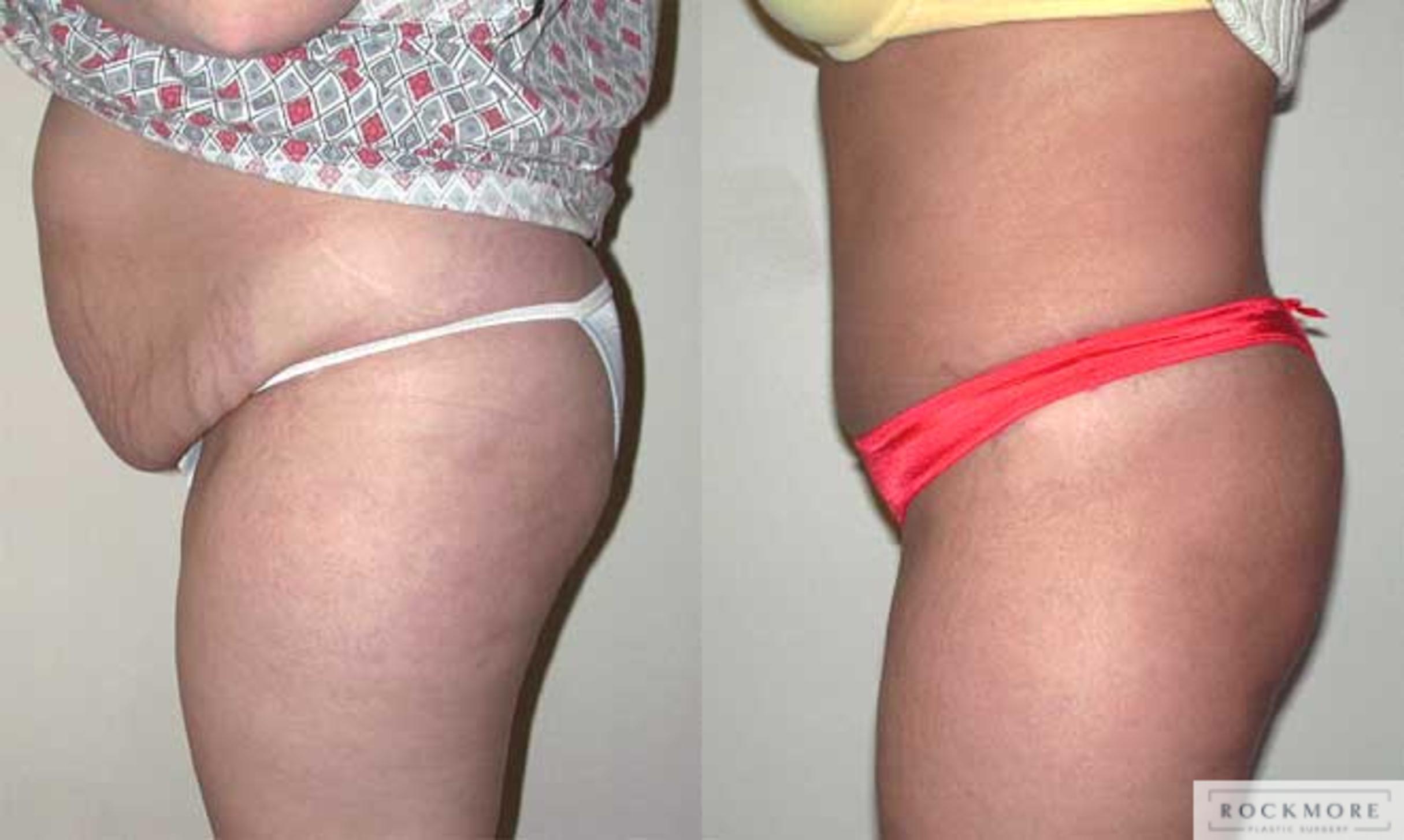 Before & After Tummy Tuck Case 30 View #3 View in Albany & Latham, New York