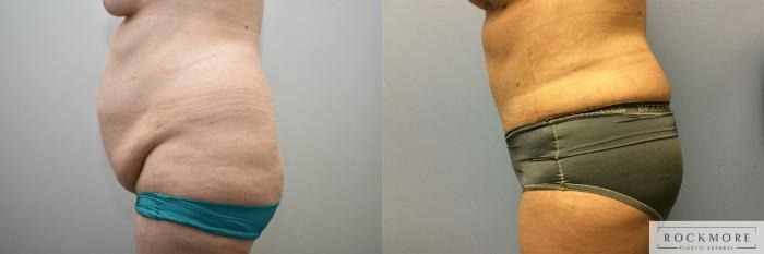 Before & After Tummy Tuck Case 314 View #2 View in Albany & Latham, New York