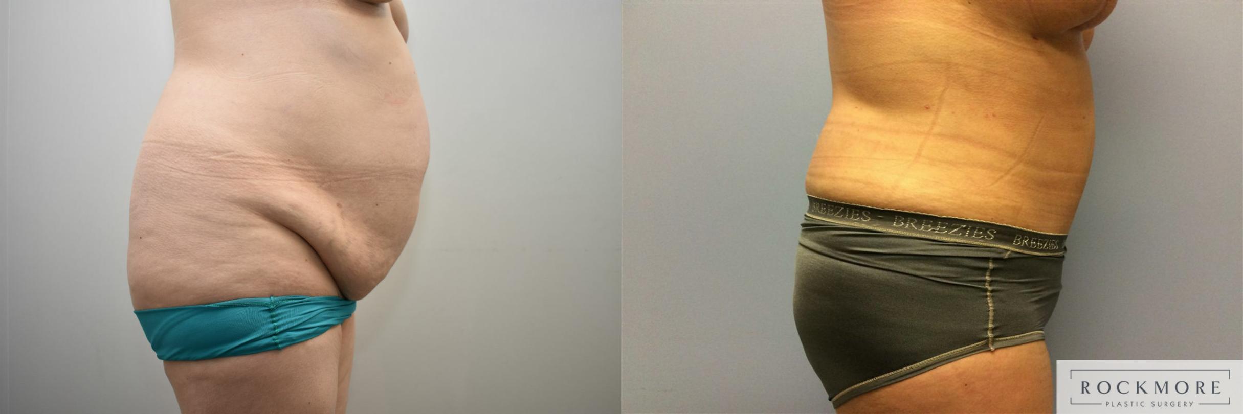 Before & After Tummy Tuck Case 314 View #3 View in Albany & Latham, New York