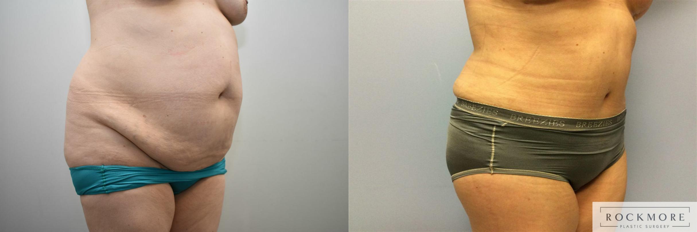 Before & After Tummy Tuck Case 314 View #4 View in Albany & Latham, New York