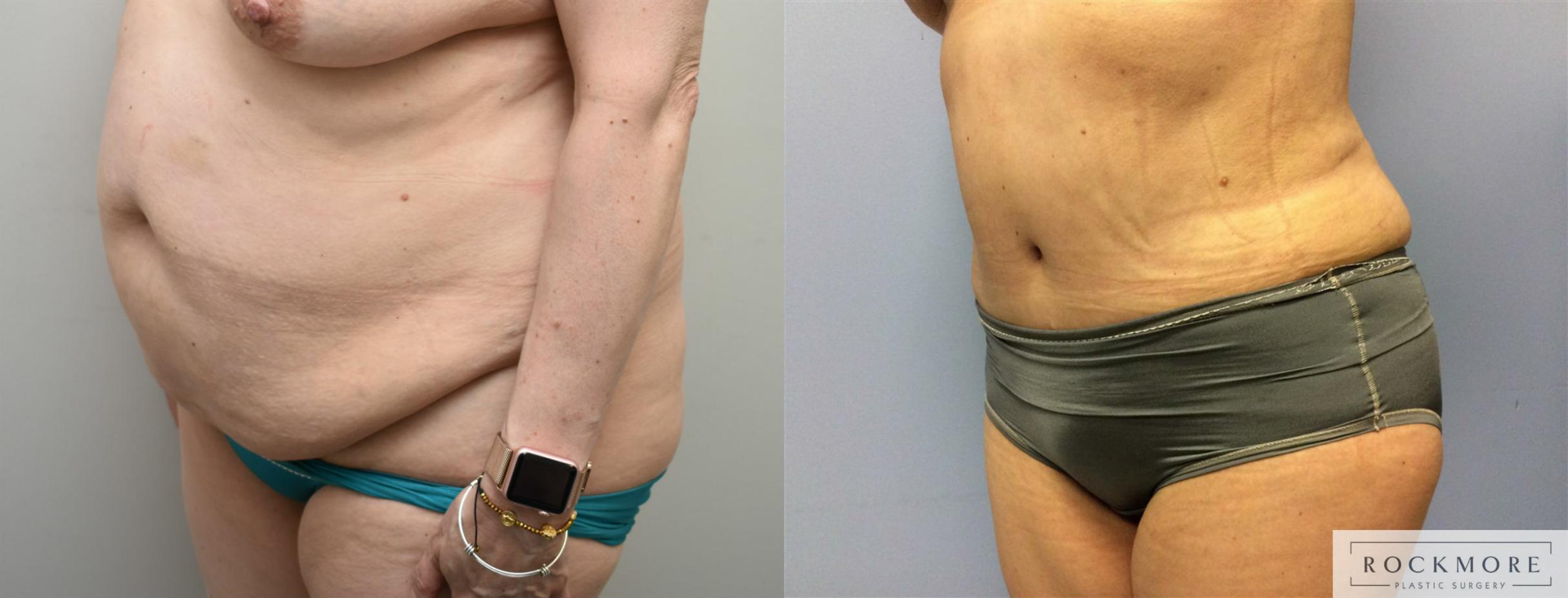 Before & After Tummy Tuck Case 314 View #5 View in Albany & Latham, New York