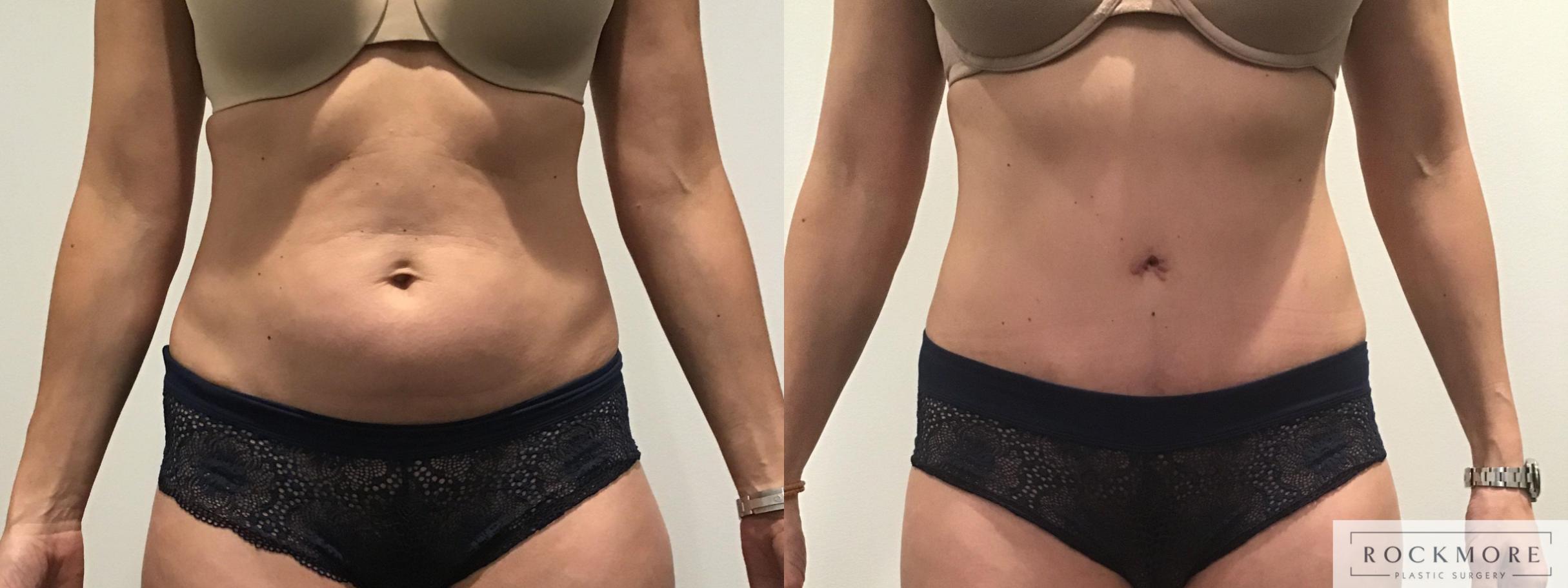 Before & After Tummy Tuck Case 328 Front View in Albany & Latham, New York
