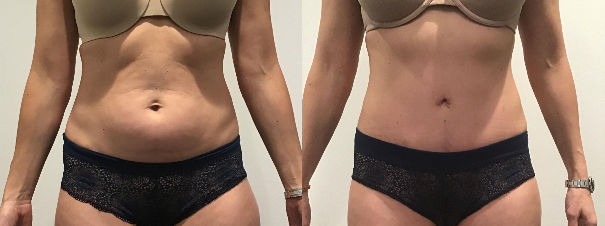 Tummy Tuck Before and After Pictures Case 171