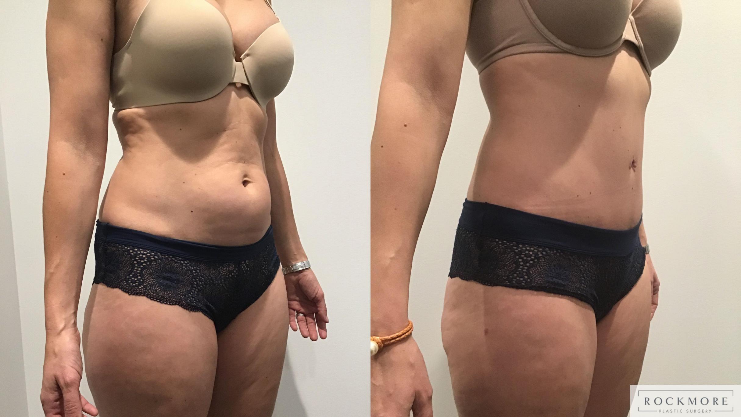 Before & After Tummy Tuck Case 328 Right Oblique View in Albany & Latham, New York