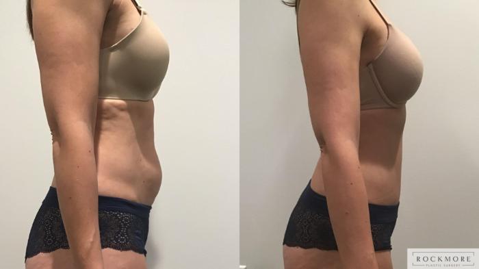 Before & After Tummy Tuck Case 328 Right Side View in Albany & Latham, New York