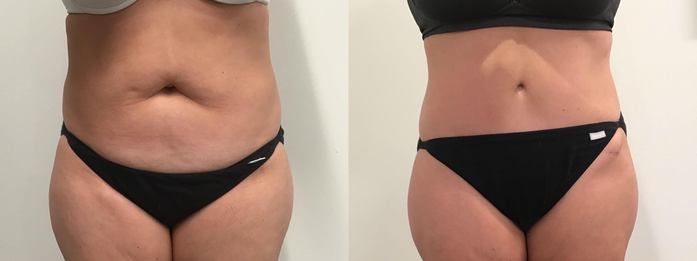 Before & After Tummy Tuck Case 329 Front View in Albany, Latham & Saratoga, New York