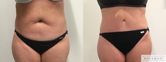 Before & After Tummy Tuck Case 329 Front View in Albany & Latham, New York