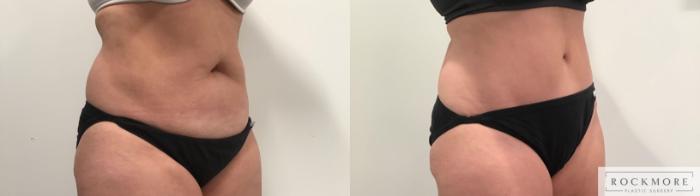 Before & After Tummy Tuck Case 329 Right Oblique View in Albany & Latham, New York