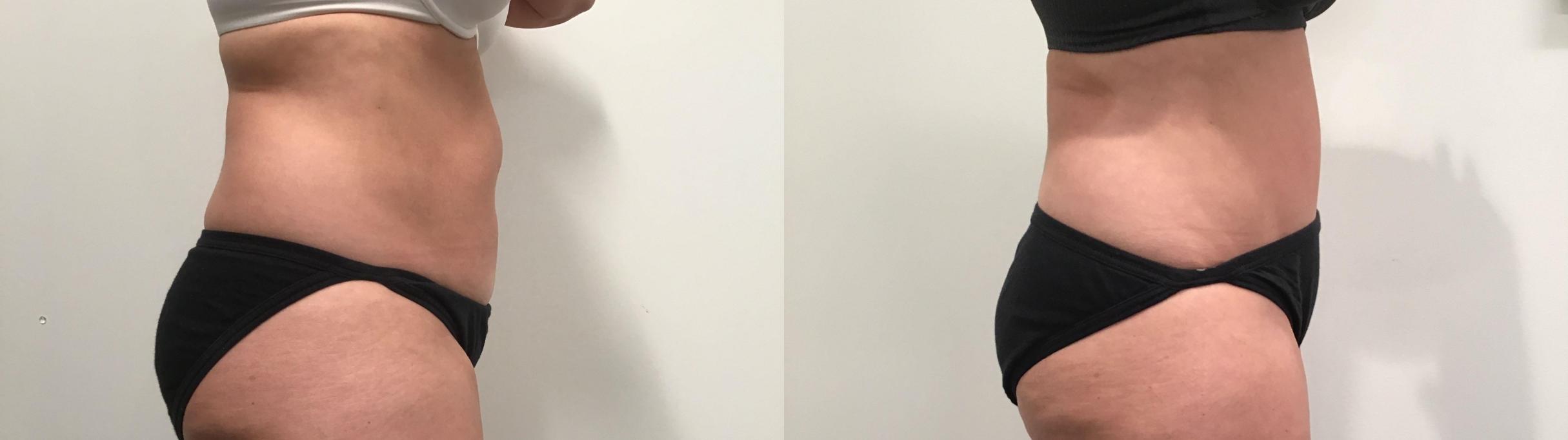 Before & After Tummy Tuck Case 329 Right Side View in Albany & Latham, New York