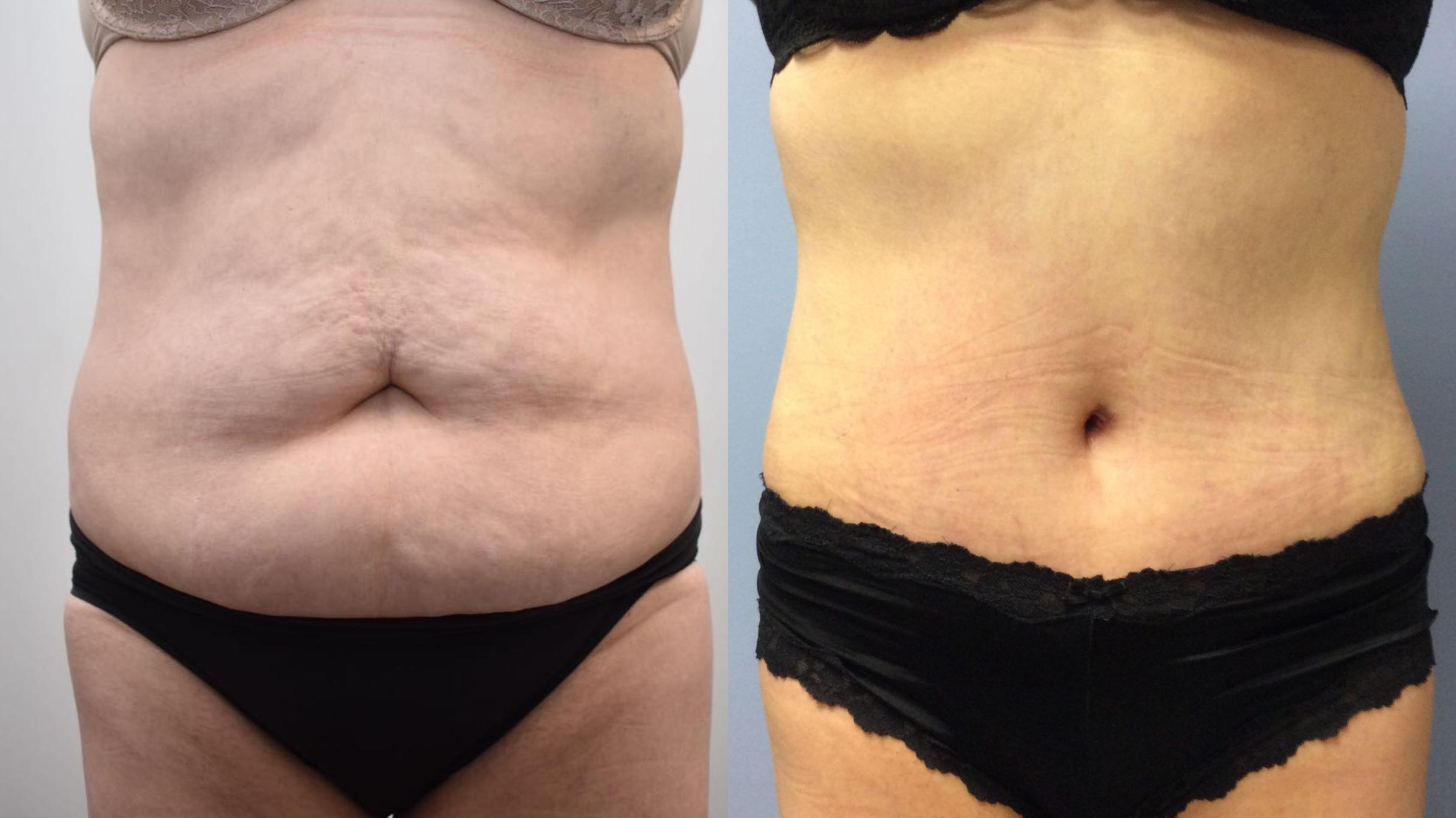 Before & After Tummy Tuck Case 343 Front View in Albany & Latham, New York