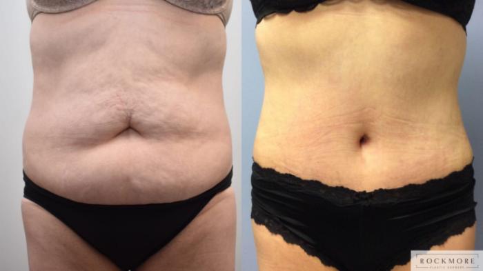Before & After Tummy Tuck Case 343 Front View in Albany & Latham, New York