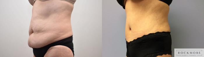 Before & After Tummy Tuck Case 343 Right Oblique View in Albany & Latham, New York