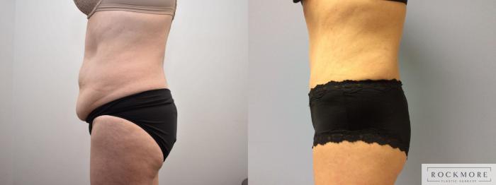 Before & After Tummy Tuck Case 343 Right Side View in Albany & Latham, New York