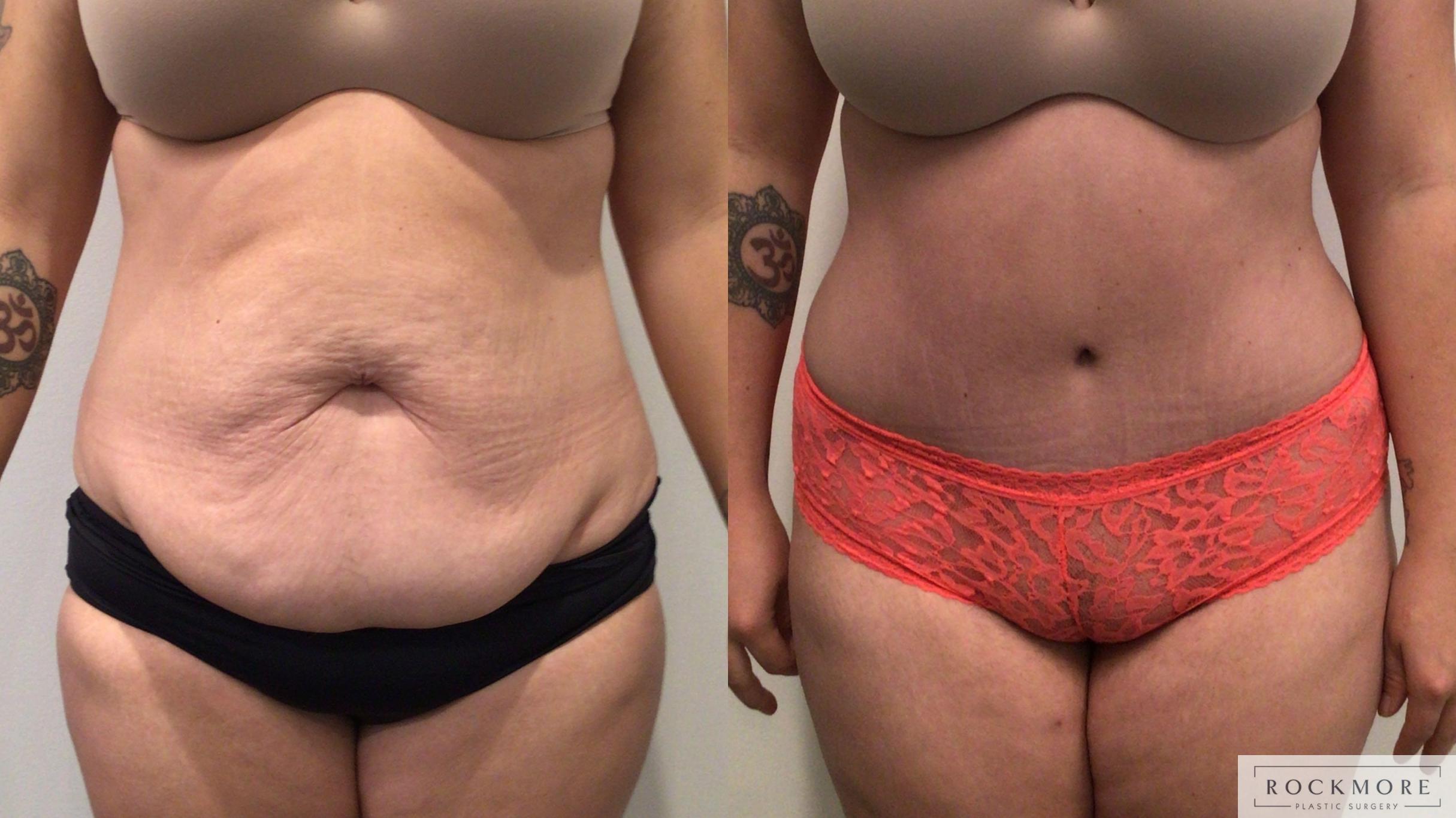 Before & After Tummy Tuck Case 447 Front View in Albany & Latham, New York