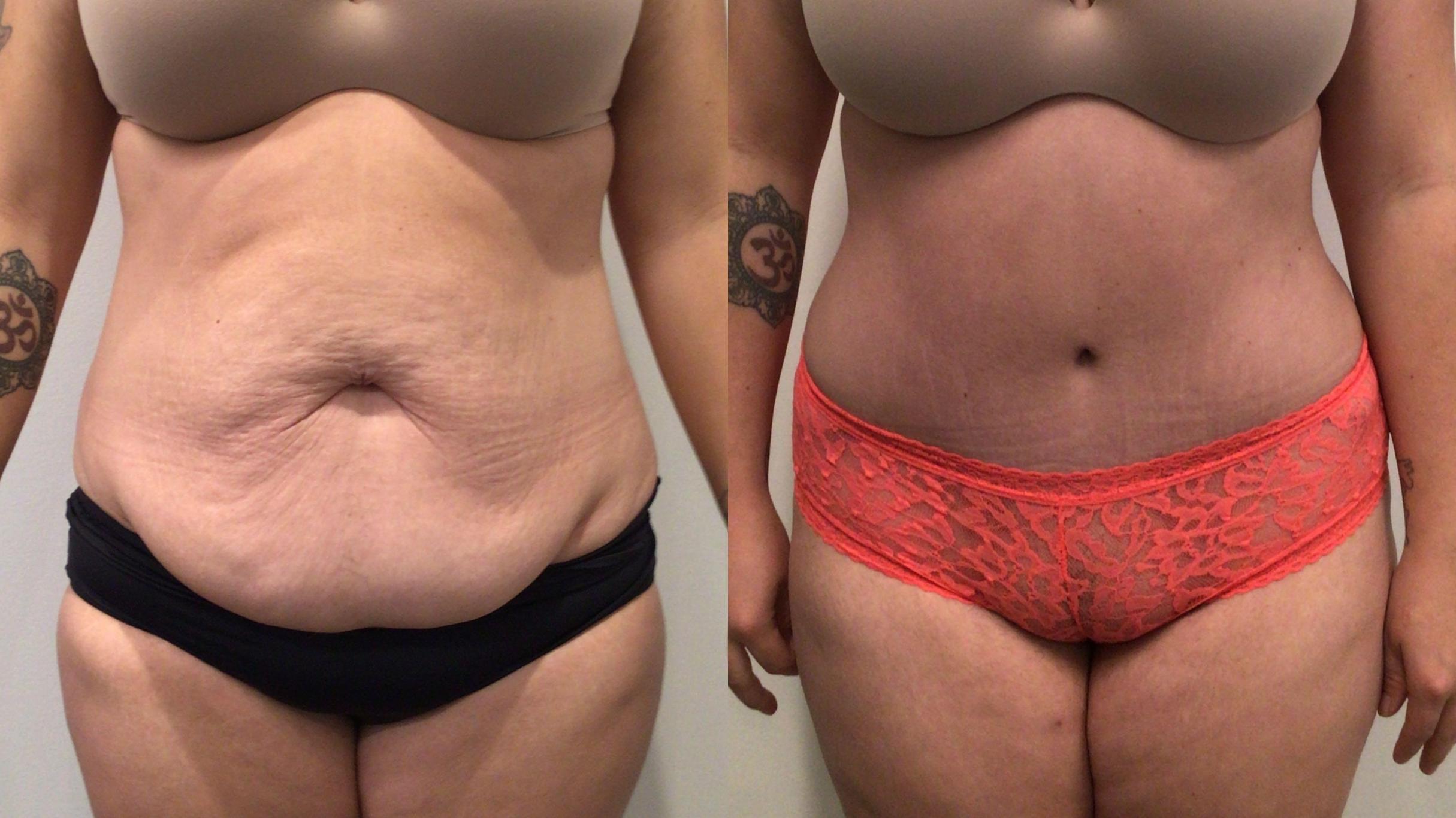 Before & After Tummy Tuck Case 447 Front View in Albany, Latham & Saratoga, New York