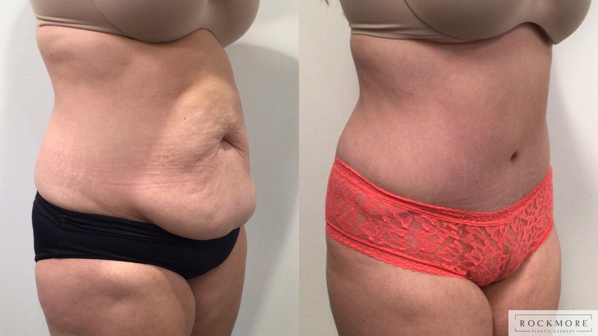 Before & After Tummy Tuck Case 447 Left Oblique View in Albany & Latham, New York