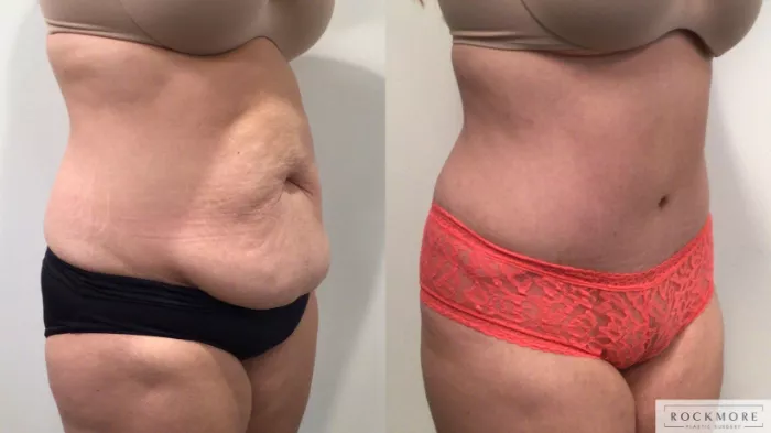 Tummy Tuck Before and After Pictures Case 364