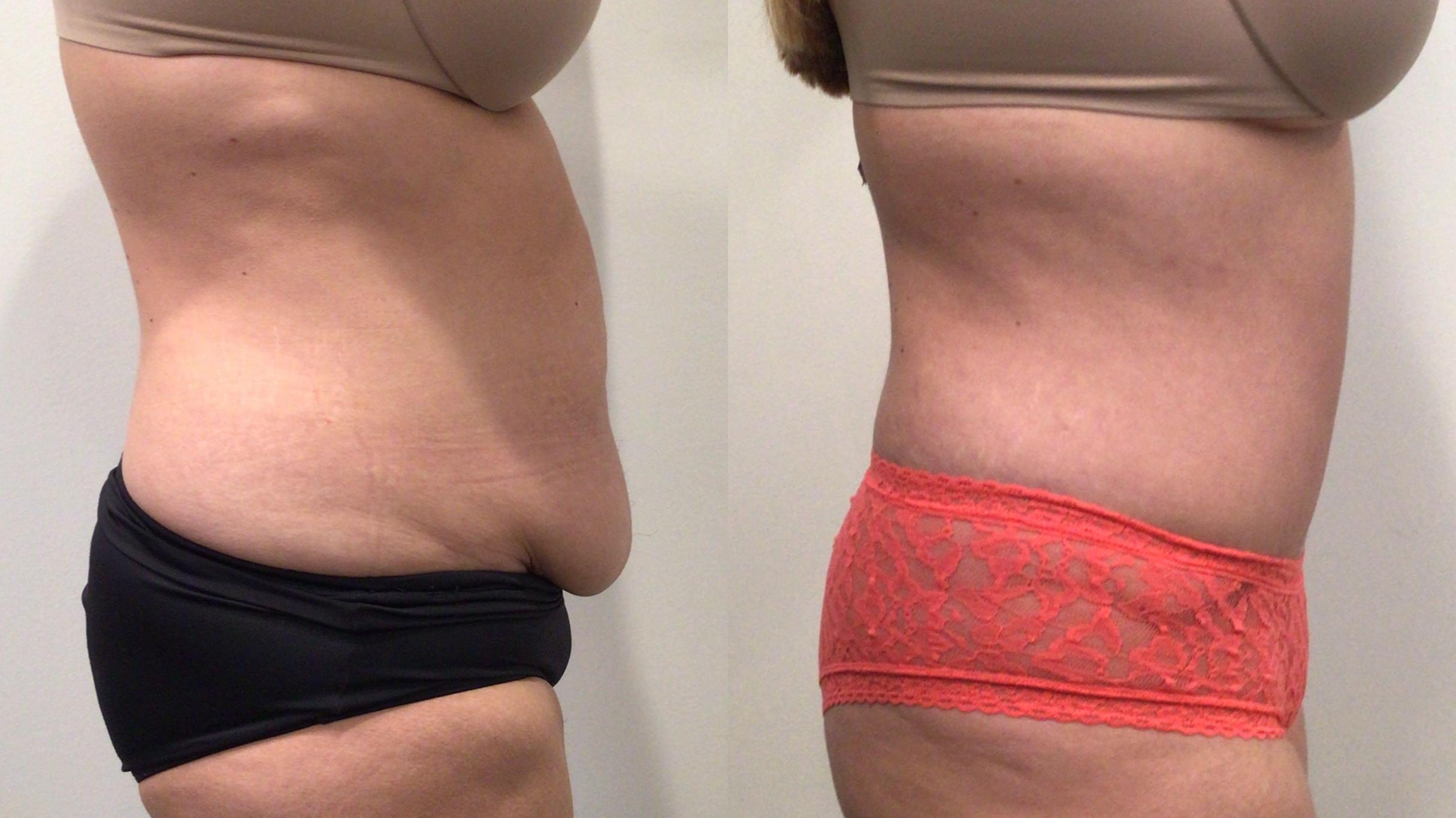 Before & After Tummy Tuck Case 447 Left Side View in Albany, Latham & Saratoga, New York