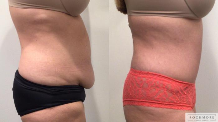 Before & After Tummy Tuck Case 447 Left Side View in Albany & Latham, New York