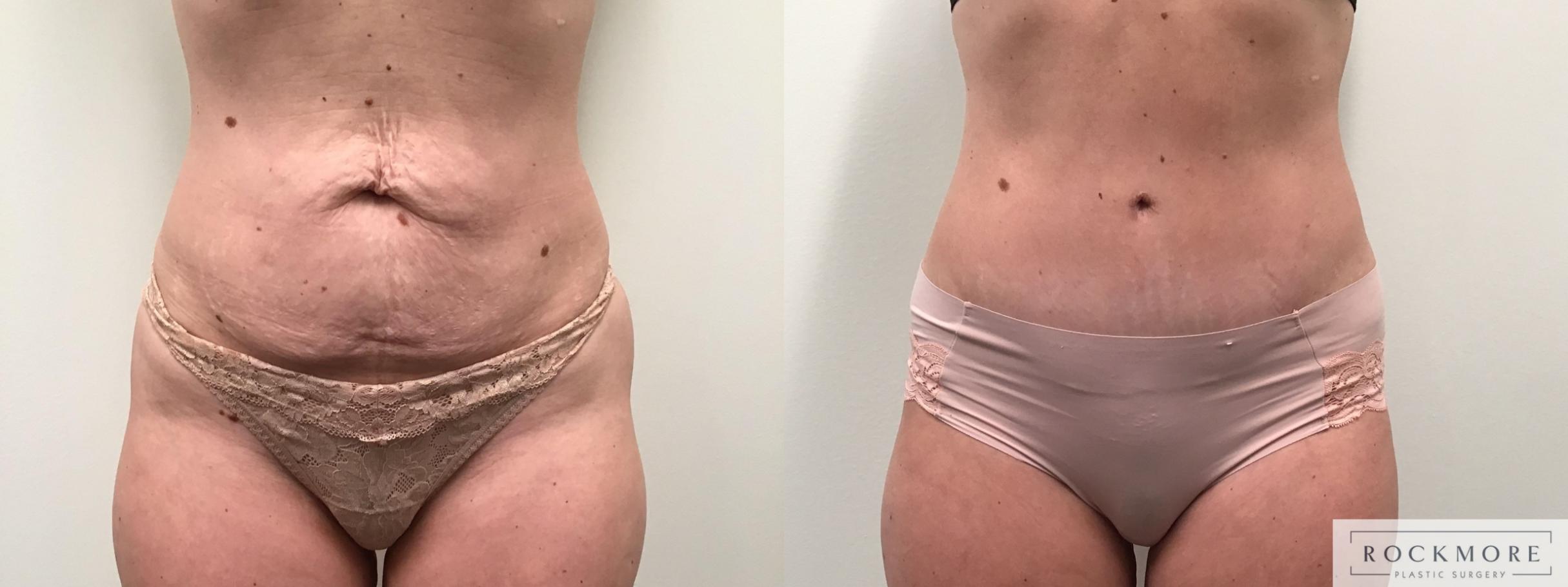 Before & After Tummy Tuck Case 455 Front View in Albany & Latham, New York