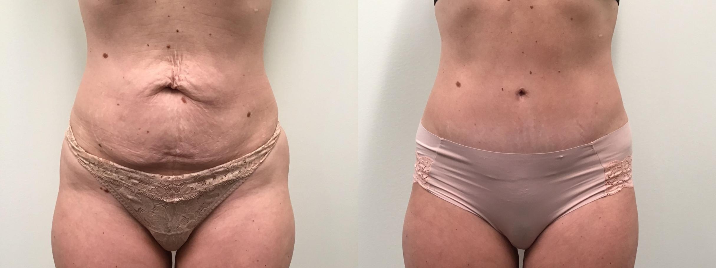 Before & After Tummy Tuck Case 455 Front View in Albany, Latham & Saratoga, New York