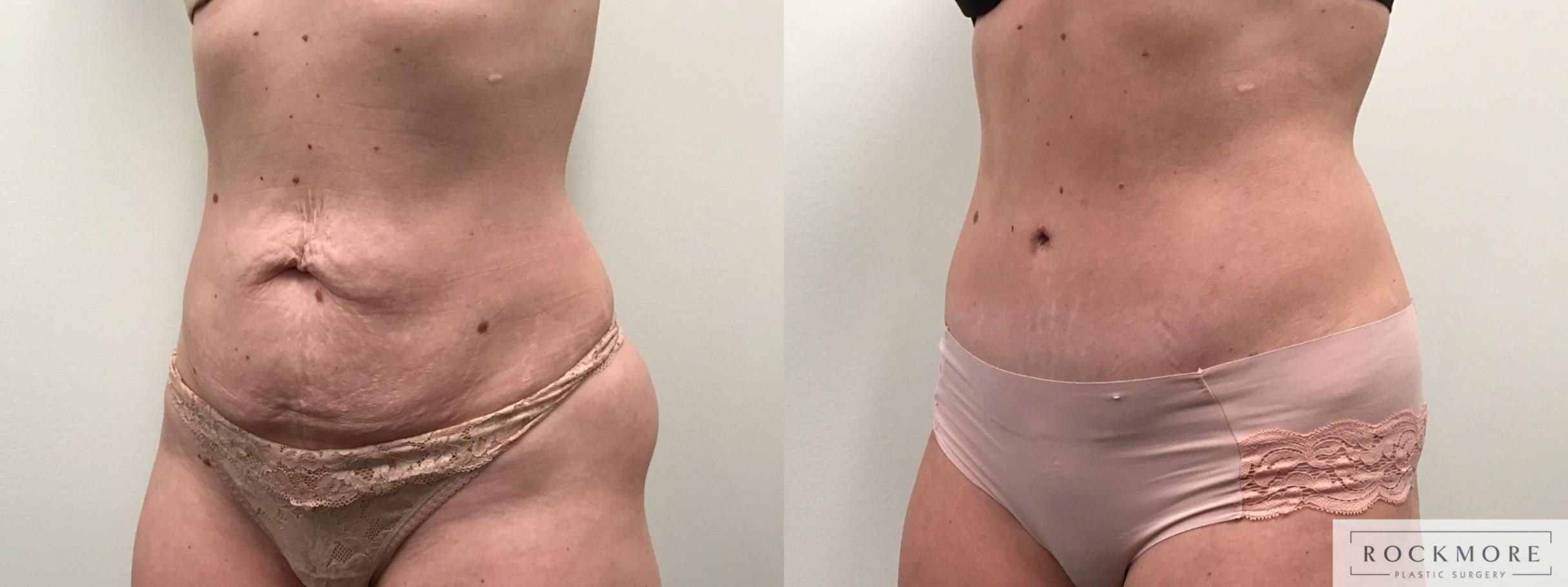 Before & After Tummy Tuck Case 455 Left Side View in Albany & Latham, New York