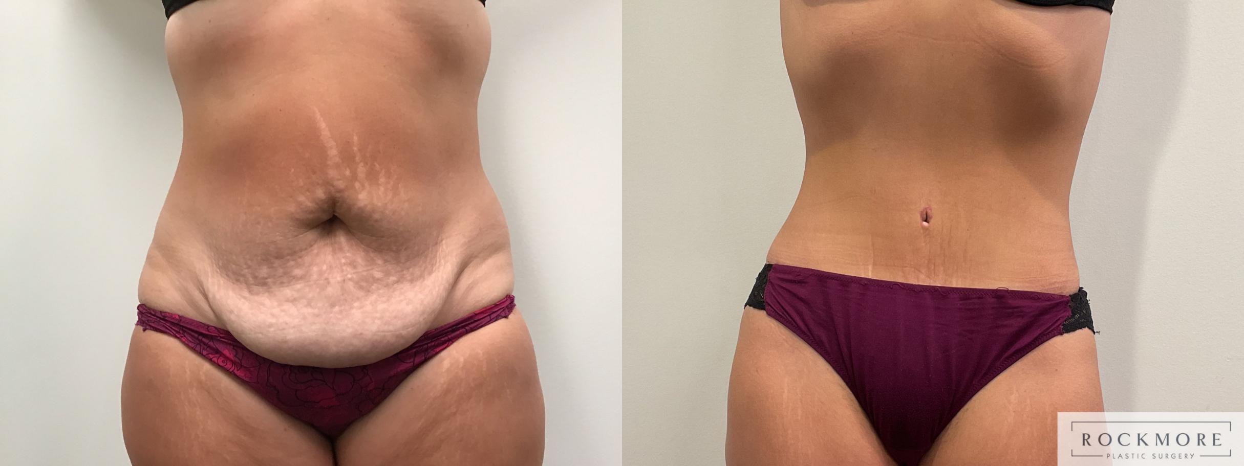 Before & After Tummy Tuck Case 459 Front View in Albany & Latham, New York