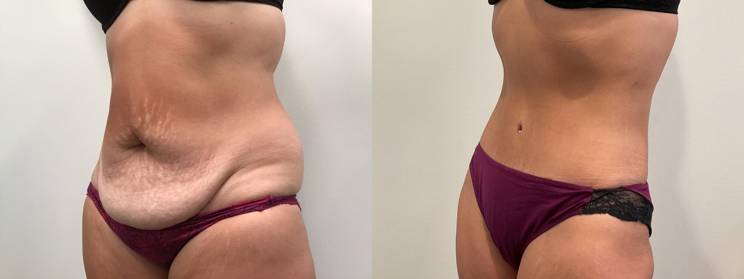 Before & After Tummy Tuck Case 459 Left Oblique View in Albany, Latham & Saratoga, New York