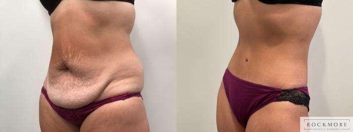 Before & After Tummy Tuck Case 459 Left Oblique View in Albany & Latham, New York