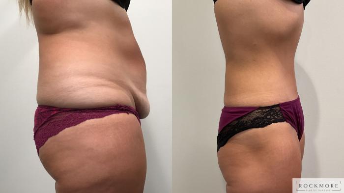 Before & After Tummy Tuck Case 459 Right Side View in Albany & Latham, New York