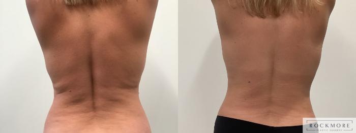Before & After Liposuction Case 464 Back View in Albany & Latham, New York