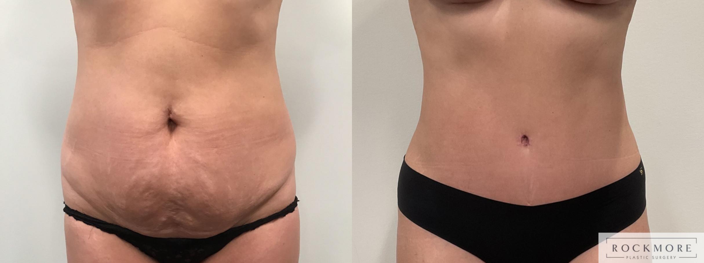 Before & After Tummy Tuck Case 464 Front View in Albany & Latham, New York