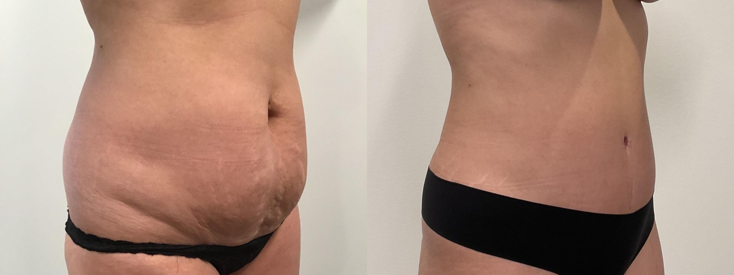 Before & After Tummy Tuck Case 464 Right Oblique View in Albany, Latham & Saratoga, New York