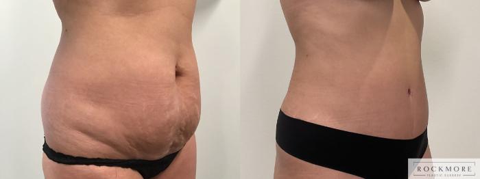 Before & After Liposuction Case 464 Right Oblique View in Albany & Latham, New York