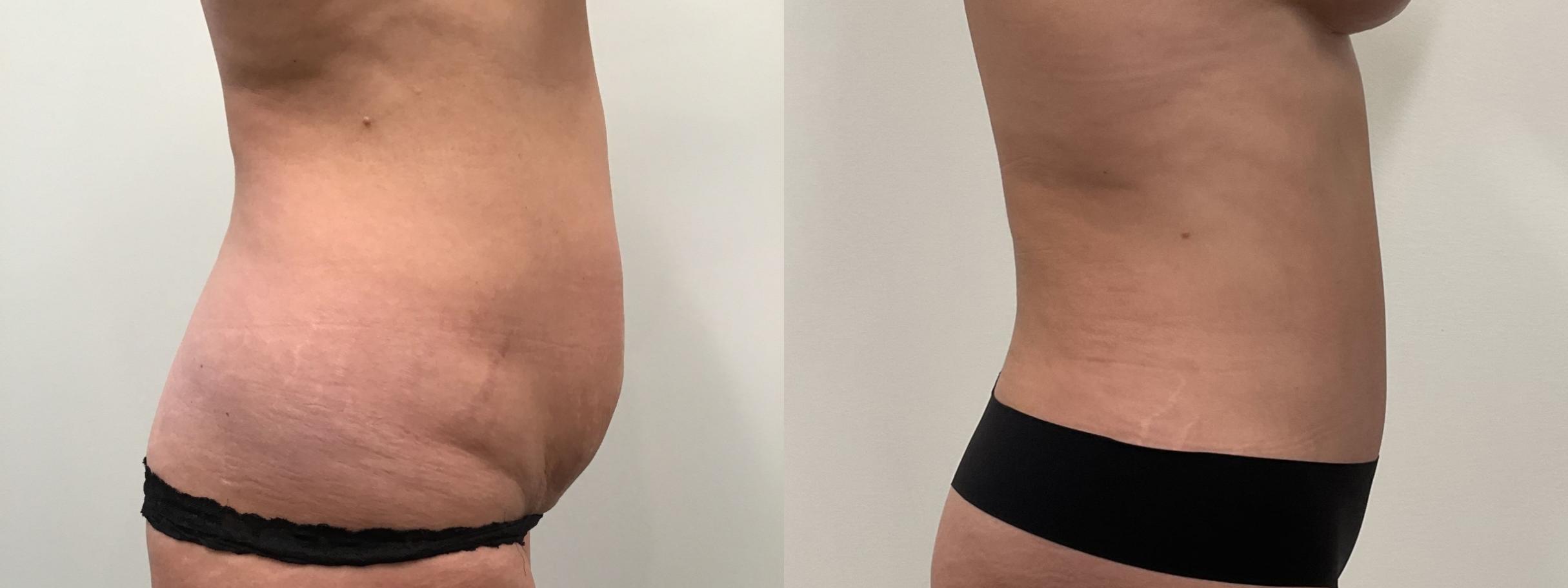 Before & After Tummy Tuck Case 464 Right Side View in Albany, Latham & Saratoga, New York