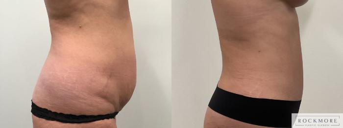 Before & After Liposuction Case 464 Right Side View in Albany & Latham, New York