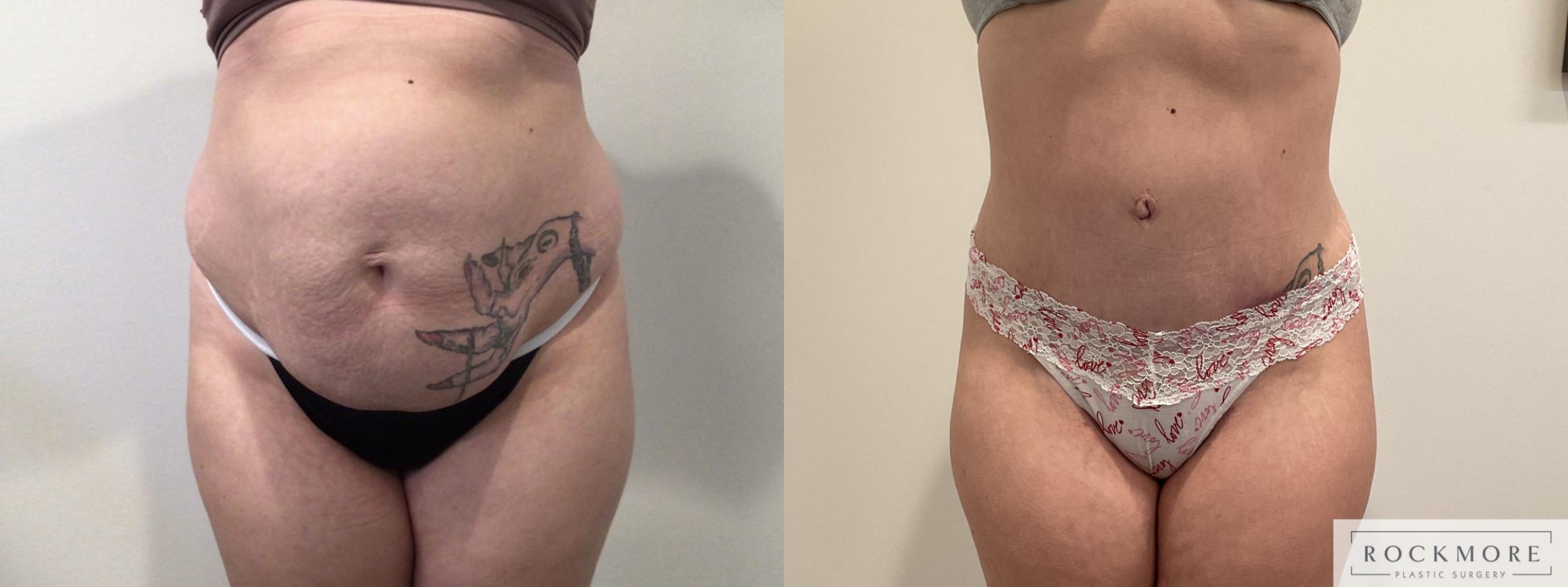 Before & After Tummy Tuck Case 469 Front View in Albany & Latham, New York