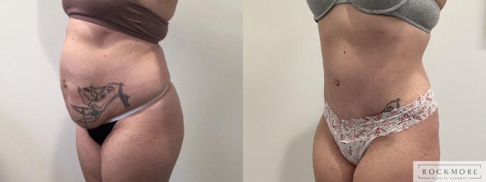 Before & After Tummy Tuck Case 469 Left Oblique View in Albany & Latham, New York