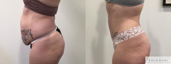 Before & After Tummy Tuck Case 469 Left Side View in Albany & Latham, New York