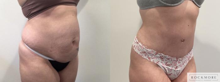 Before & After Tummy Tuck Case 469 Right Oblique View in Albany & Latham, New York