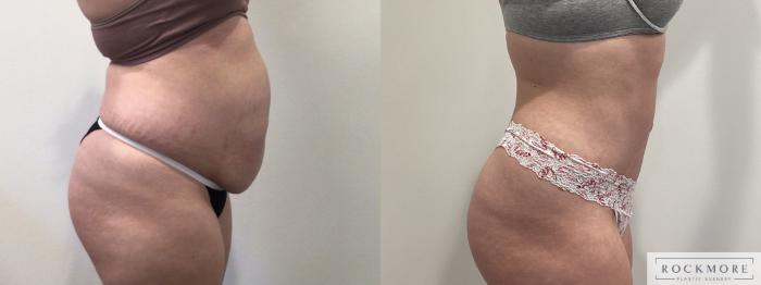 Before & After Tummy Tuck Case 469 Right Side View in Albany & Latham, New York