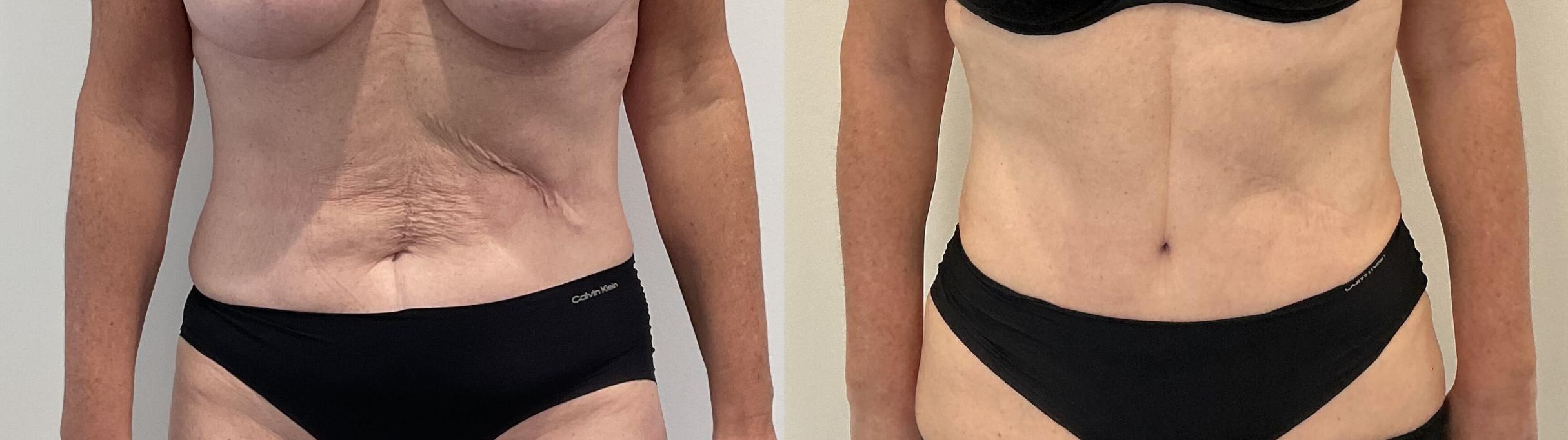 Before & After Tummy Tuck Case 482 Front View in Albany, Latham & Saratoga, New York