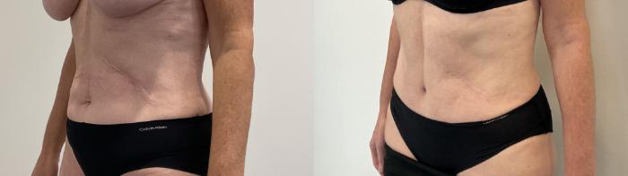 Before & After Tummy Tuck Case 482 Left Oblique View in Albany, Latham & Saratoga, New York