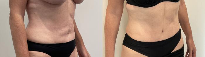 Before & After Tummy Tuck Case 482 Right Oblique View in Albany, Latham & Saratoga, New York