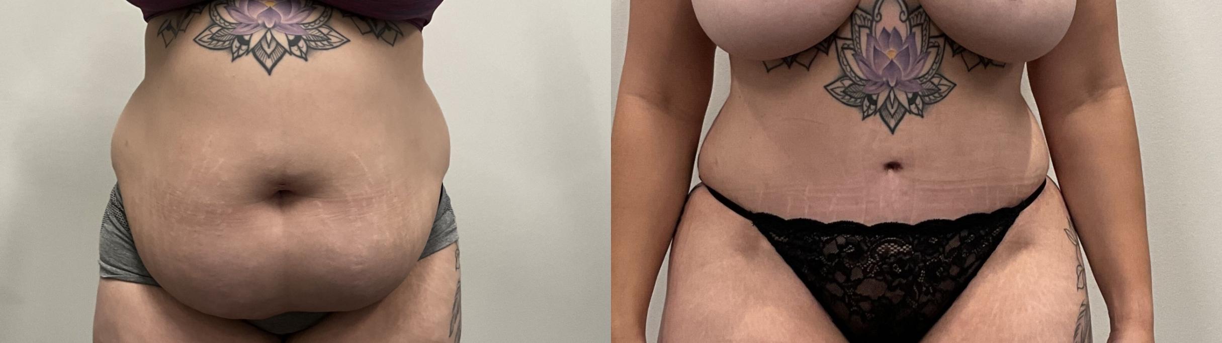 Before & After Tummy Tuck Case 485 Front View in Albany, Latham & Saratoga, New York