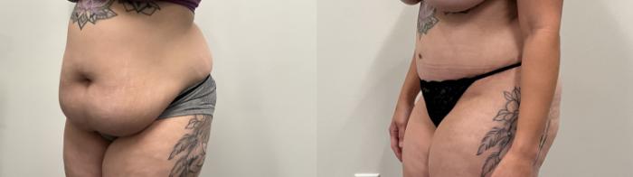 Before & After Tummy Tuck Case 485 Left Oblique View in Albany, Latham & Saratoga, New York