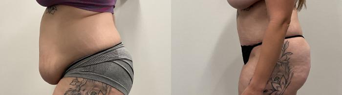 Before & After Tummy Tuck Case 485 Left Side View in Albany, Latham & Saratoga, New York