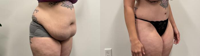 Before & After Tummy Tuck Case 485 Right Oblique View in Albany, Latham & Saratoga, New York