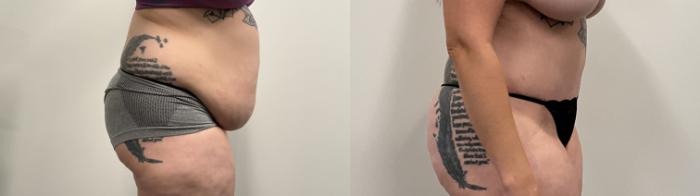Before & After Tummy Tuck Case 485 Right Side View in Albany, Latham & Saratoga, New York