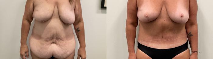 Before & After Breast Lift Case 486 Front View in Albany, Latham & Saratoga, New York
